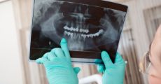 La Importancia del Mantenimiento de los Implantes Dentales: Garantizando una Sonrisa Duradera